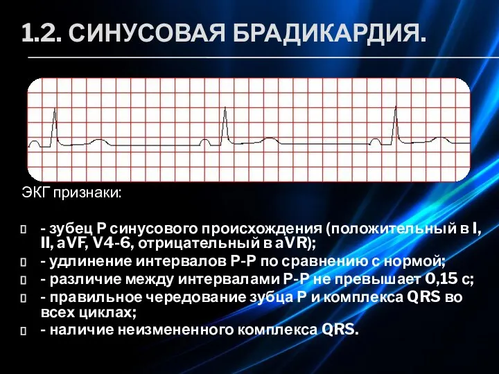 1.2. СИНУСОВАЯ БРАДИКАРДИЯ. ЭКГ признаки: - зубец Р синусового происхождения (положительный в