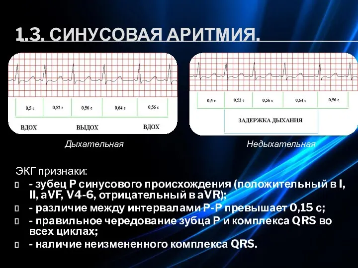 1.3. СИНУСОВАЯ АРИТМИЯ. ЭКГ признаки: - зубец Р синусового происхождения (положительный в