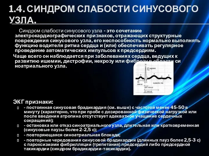 1.4. СИНДРОМ СЛАБОСТИ СИНУСОВОГО УЗЛА. Синдром слабости синусового узла - это сочетание