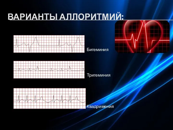 ВАРИАНТЫ АЛЛОРИТМИЙ: Бигеминия Тригеминия Квадримения