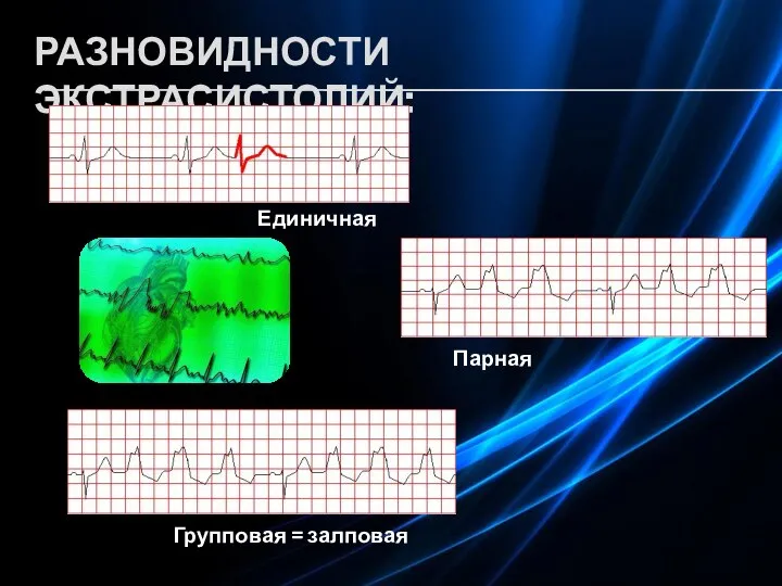 РАЗНОВИДНОСТИ ЭКСТРАСИСТОЛИЙ: Единичная Парная Групповая = залповая