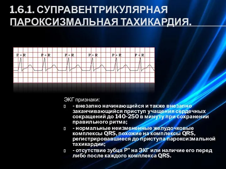 1.6.1. СУПРАВЕНТРИКУЛЯРНАЯ ПАРОКСИЗМАЛЬНАЯ ТАХИКАРДИЯ. ЭКГ признаки: - внезапно начинающийся и также внезапно