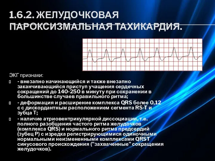 1.6.2. ЖЕЛУДОЧКОВАЯ ПАРОКСИЗМАЛЬНАЯ ТАХИКАРДИЯ. ЭКГ признаки: - внезапно начинающийся и также внезапно