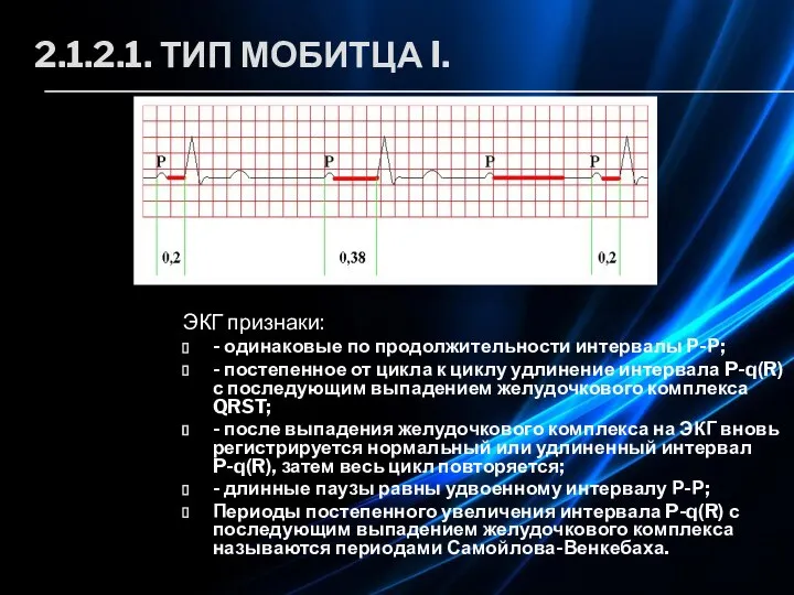 2.1.2.1. ТИП МОБИТЦА I. ЭКГ признаки: - одинаковые по продолжительности интервалы Р-Р;