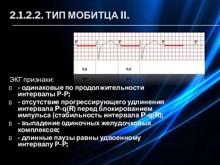 2.1.2.2. ТИП МОБИТЦА II. ЭКГ признаки: - одинаковые по продолжительности интервалы Р-Р;