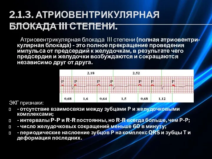 2.1.3. АТРИОВЕНТРИКУЛЯРНАЯ БЛОКАДА III СТЕПЕНИ. Атриовентрикулярная блокада III степени (полная атриовентри-кулярная блокада)