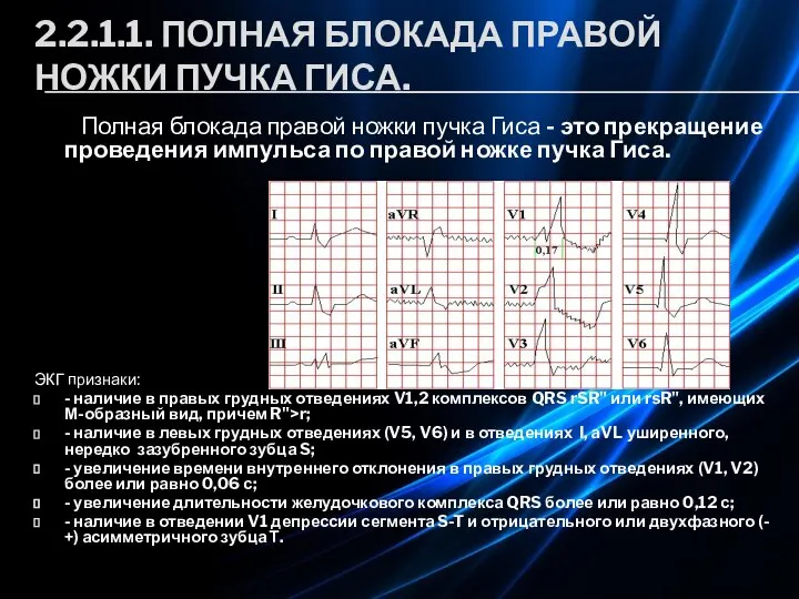 2.2.1.1. ПОЛНАЯ БЛОКАДА ПРАВОЙ НОЖКИ ПУЧКА ГИСА. Полная блокада правой ножки пучка