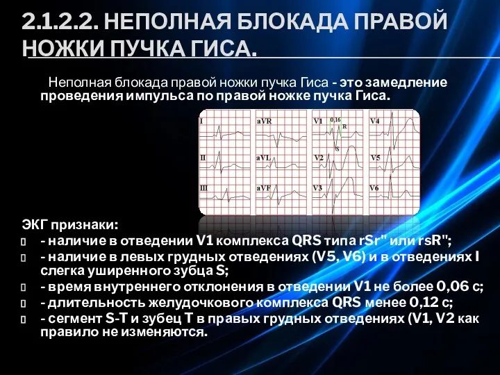 2.1.2.2. НЕПОЛНАЯ БЛОКАДА ПРАВОЙ НОЖКИ ПУЧКА ГИСА. Неполная блокада правой ножки пучка