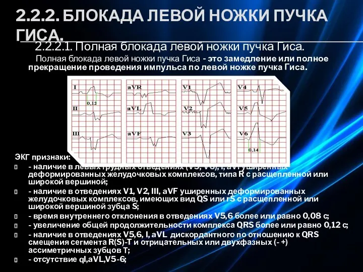 2.2.2. БЛОКАДА ЛЕВОЙ НОЖКИ ПУЧКА ГИСА. 2.2.2.1. Полная блокада левой ножки пучка