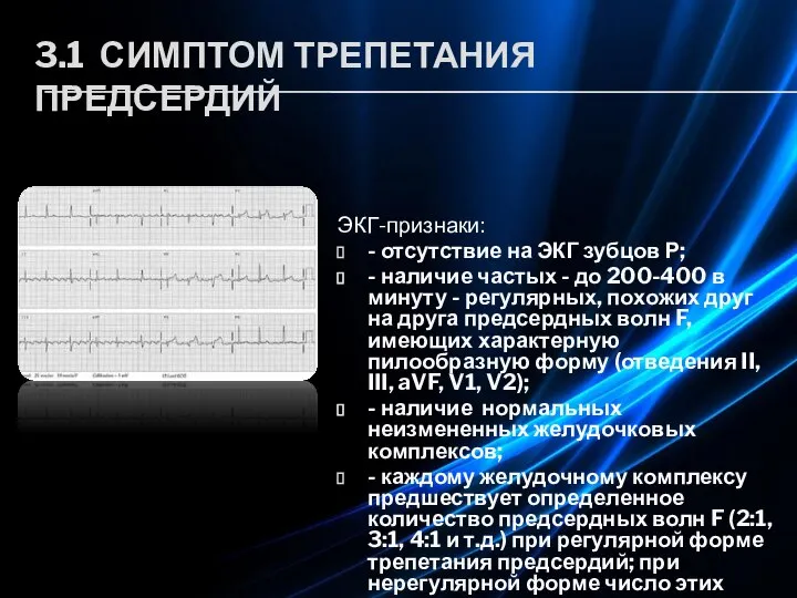 3.1 СИМПТОМ ТРЕПЕТАНИЯ ПРЕДСЕРДИЙ ЭКГ-признаки: - отсутствие на ЭКГ зубцов Р; -