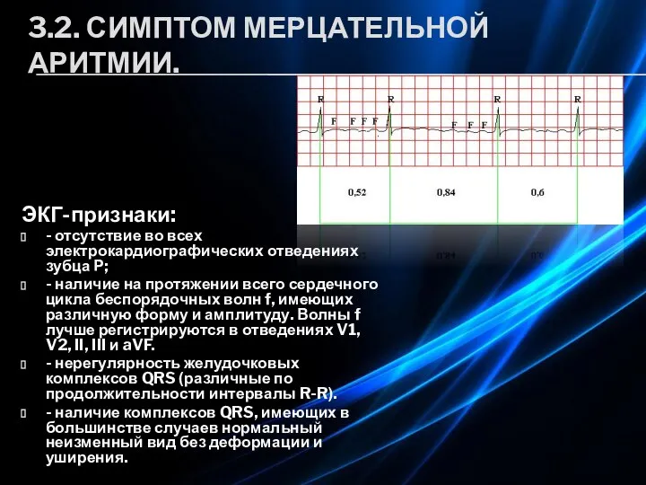 3.2. СИМПТОМ МЕРЦАТЕЛЬНОЙ АРИТМИИ. ЭКГ-признаки: - отсутствие во всех электрокардиографических отведениях зубца