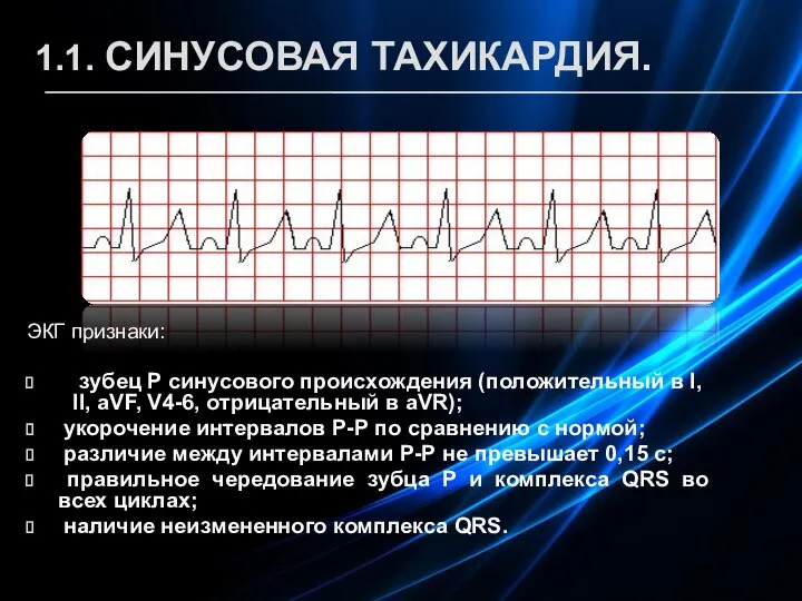 1.1. СИНУСОВАЯ ТАХИКАРДИЯ. ЭКГ признаки: зубец Р синусового происхождения (положительный в I,