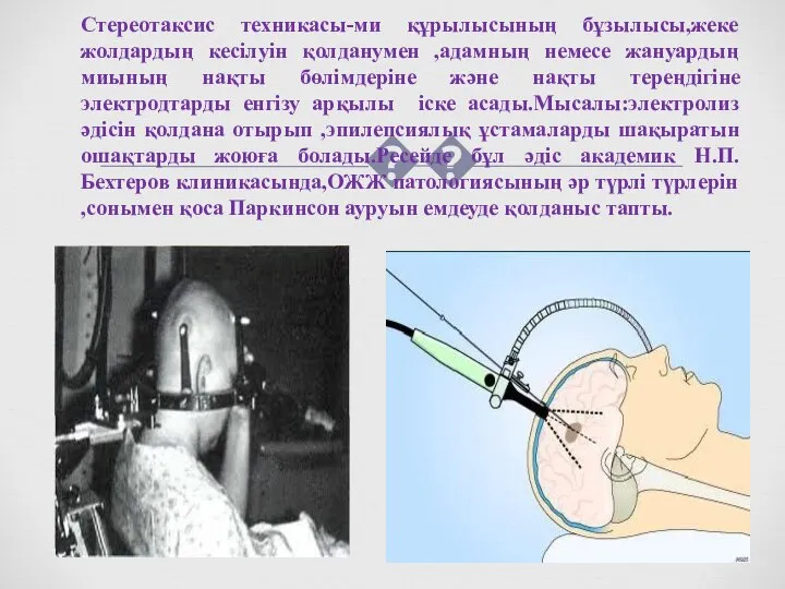 Стереотаксис техникасы-ми құрылысының бұзылысы,жеке жолдардың кесілуін қолданумен ,адамның немесе жануардың миының нақты