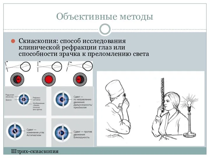 Объективные методы Скиаскопия: способ исследования клинической рефракции глаз или способности зрачка к преломлению света Штрих-скиаскопия