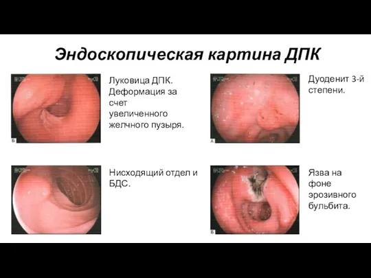 Эндоскопическая картина ДПК Нисходящий отдел и БДС. Луковица ДПК. Деформация за счет