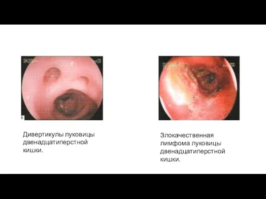 Злокачественная лимфома луковицы двенадцатиперстной кишки. Дивертикулы луковицы двенадцатиперстной кишки.