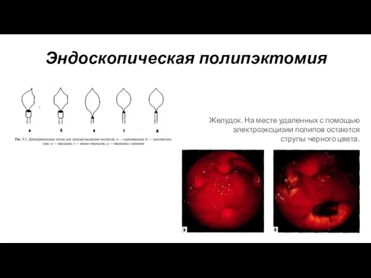 Эндоскопическая полипэктомия Желудок. На месте удаленных с помощью электроэксцизии полипов остаются струпы черного цвета.