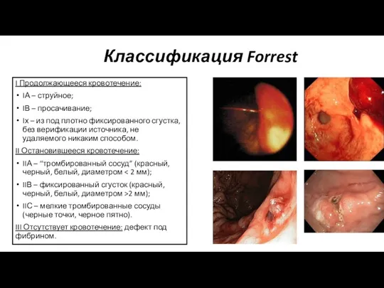 Классификация Forrest I Продолжающееся кровотечение: IА – струйное; IВ – просачивание; Iх