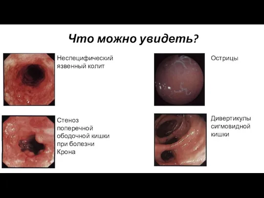 Что можно увидеть? Неспецифический язвенный колит Стеноз поперечной ободочной кишки при болезни