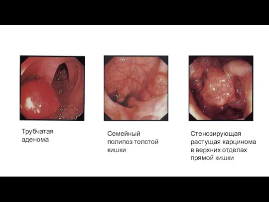 Трубчатая аденома Семейный полипоз толстой кишки Стенозирующая растущая карцинома в верхних отделах прямой кишки
