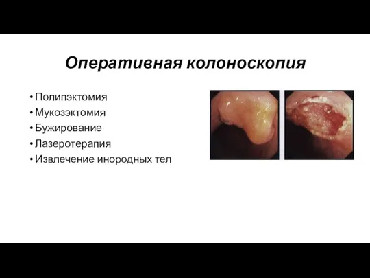 Оперативная колоноскопия Полипэктомия Мукозэктомия Бужирование Лазеротерапия Извлечение инородных тел