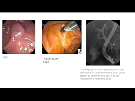 БДС Cholangiogram. Note (a) duodenoscope positioned in duodenum with tip at distal