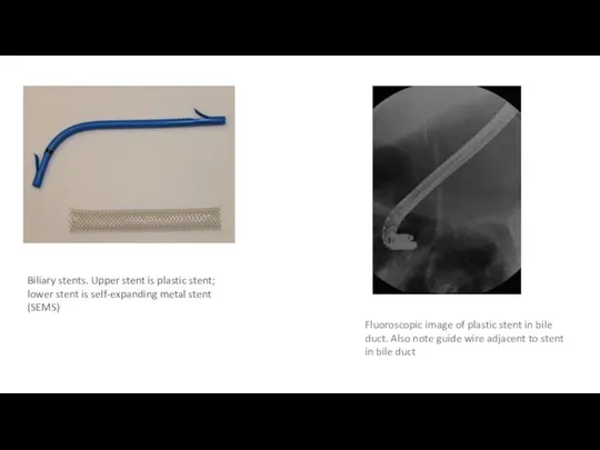 Biliary stents. Upper stent is plastic stent; lower stent is self-expanding metal