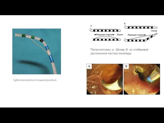 Sphincterotome in bowed position Папиллотомы: а - Шома; б- со сгибаемой дистальной частью катетера