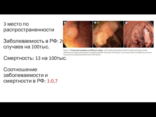 3 место по распространенности Заболеваемость в РФ: 20 случаев на 100тыс. Смертность: