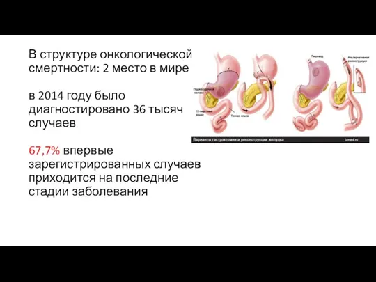 В структуре онкологической смертности: 2 место в мире в 2014 году было