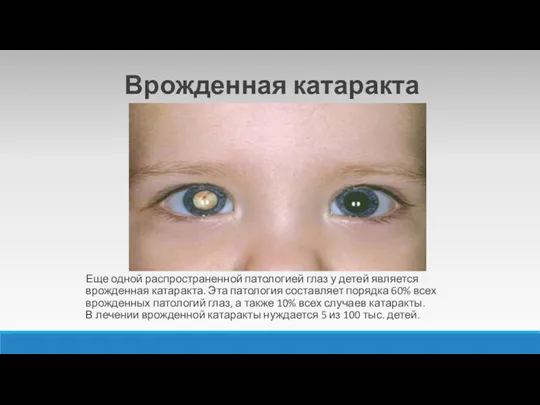 Еще одной распространенной патологией глаз у детей является врожденная катаракта. Эта патология
