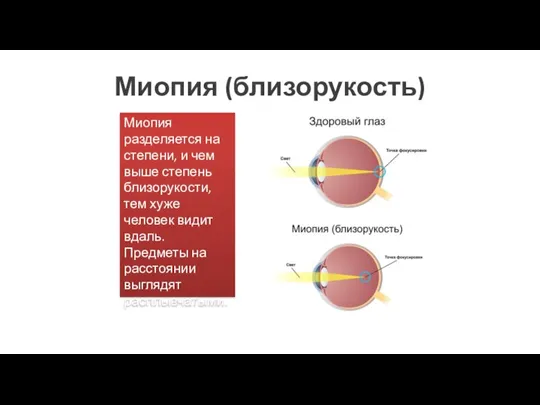 Миопия (близорукость) Миопия разделяется на степени, и чем выше степень близорукости, тем