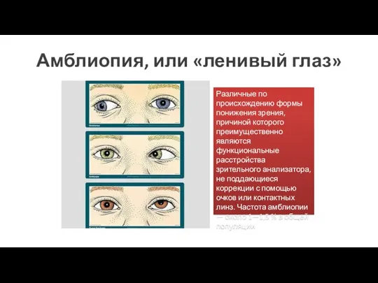 Амблиопия, или «ленивый глаз» Различные по происхождению формы понижения зрения, причиной которого
