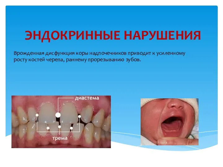 ЭНДОКРИННЫЕ НАРУШЕНИЯ Врожденная дисфункция коры надпочечников приводит к усиленному росту костей черепа, раннему прорезыванию зубов.