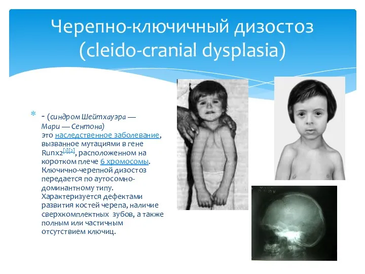 Черепно-ключичный дизостоз (cleido-cranial dysplasia) - (синдром Шейтхауэра — Мари — Сентона) это