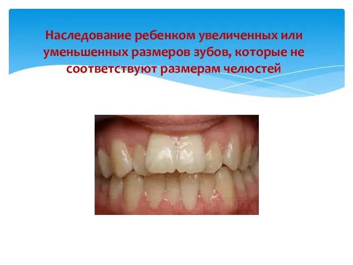 Наследование ребенком увеличенных или уменьшенных размеров зубов, которые не соответствуют размерам челюстей