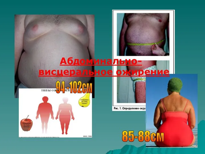 Абдоминально-висцеральное ожирение 94 -102см 85-88см