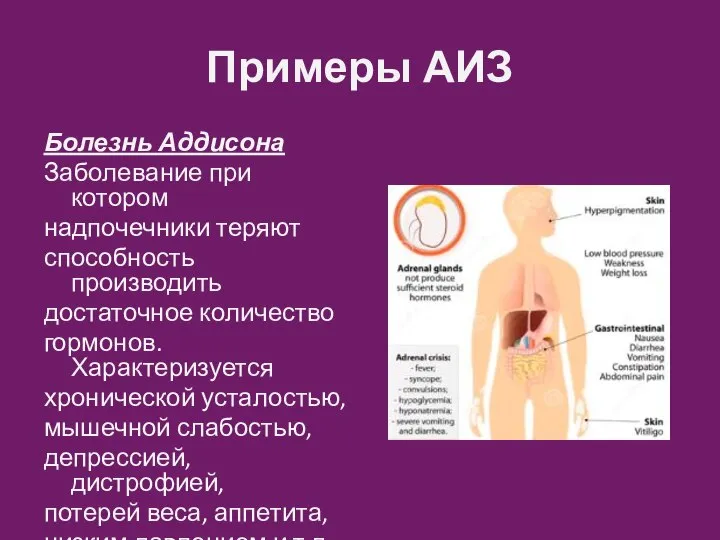 Примеры АИЗ Болезнь Аддисона Заболевание при котором надпочечники теряют способность производить достаточное