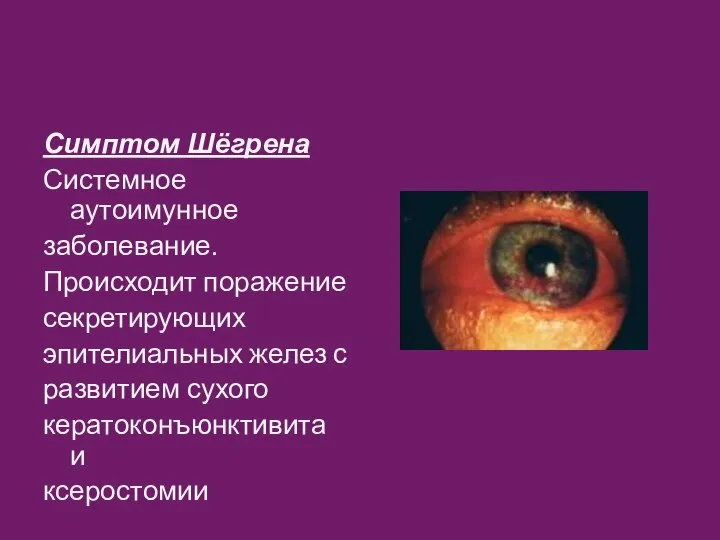 Симптом Шёгрена Системное аутоимунное заболевание. Происходит поражение секретирующих эпителиальных желез с развитием сухого кератоконъюнктивита и ксеростомии