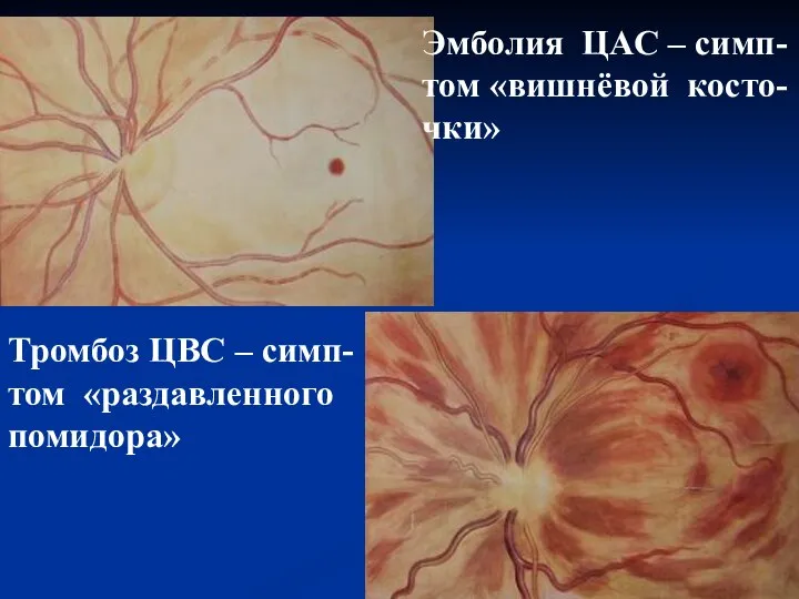 Эмболия ЦАС – симп- том «вишнёвой косто- чки» Тромбоз ЦВС – симп- том «раздавленного помидора»