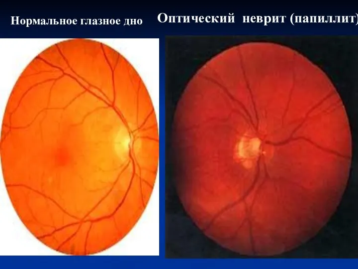 Оптический неврит (папиллит) Нормальное глазное дно