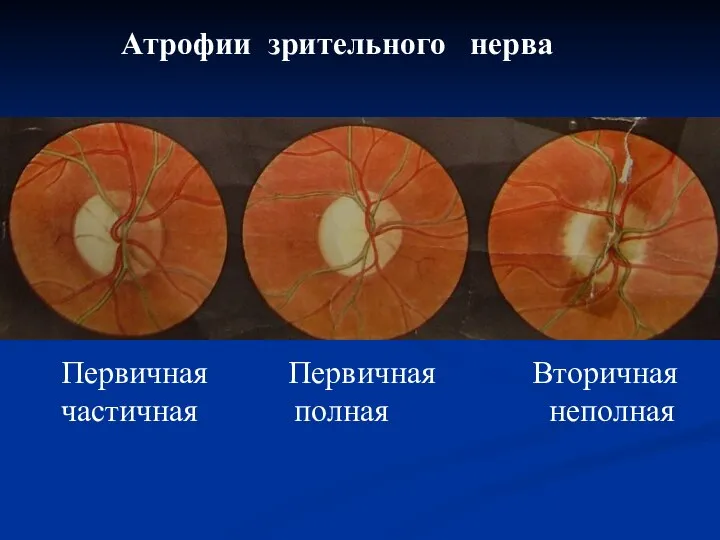 Атрофии зрительного нерва Первичная Первичная Вторичная частичная полная неполная