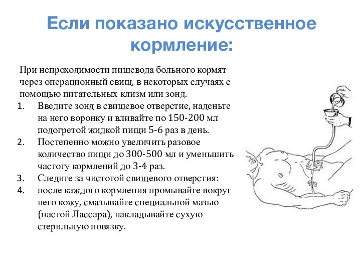 Если показано искусственное кормление: При непроходимости пищевода больного кормят через операционный свищ,