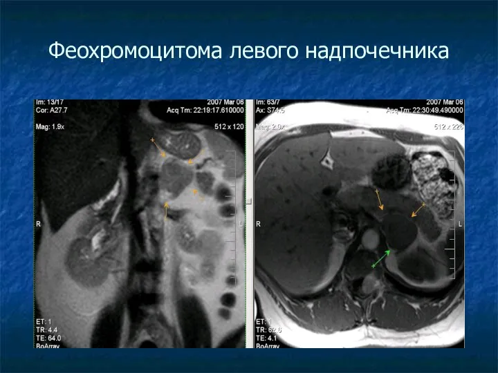 Феохромоцитома левого надпочечника