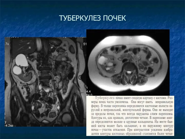 ТУБЕРКУЛЕЗ ПОЧЕК