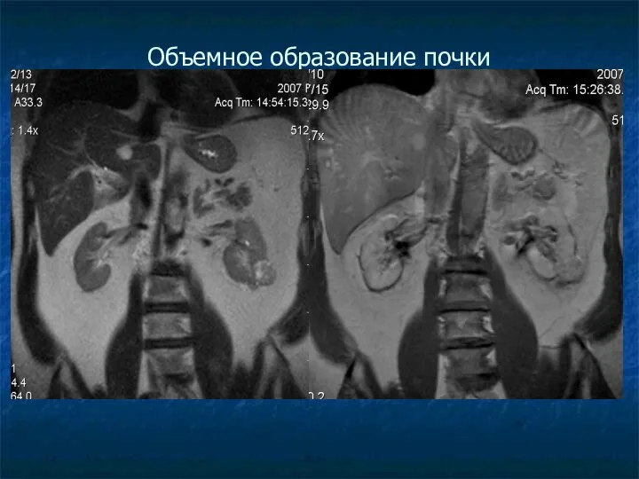 Объемное образование почки