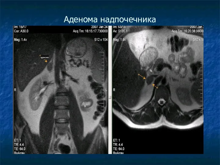 Аденома надпочечника