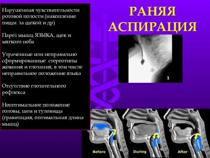 РАНЯЯ АСПИРАЦИЯ Нарушенная чувствительности ротовой полости (накопление пищи за щекой и др)