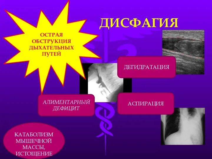 ДИСФАГИЯ КАТАБОЛИЗМ МЫШЕЧНОЙ МАССЫ, ИСТОЩЕНИЕ ДЕГИДРАТАЦИЯ АСПИРАЦИЯ АЛИМЕНТАРНЫЙ ДЕФИЦИТ ОСТРАЯ ОБСТРУКЦИЯ ДЫХАТЕЛЬНЫХ ПУТЕЙ