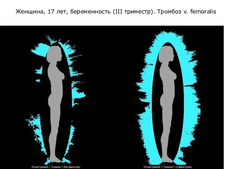 Женщина, 17 лет, беременность (III триместр). Тромбоз v. femoralis